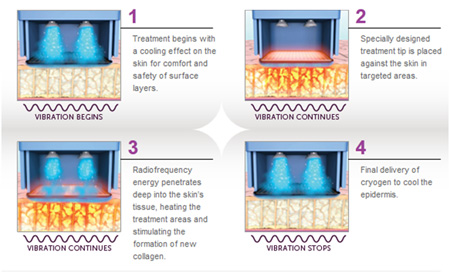 Thermage Diagram