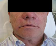 After Results for Liquid Facelift