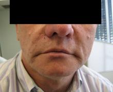 Before Results for Juvederm