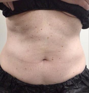 After Results for Coolsculpting