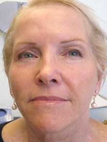 After Results for CO2 Laser Resurfacing