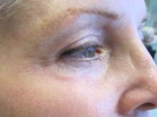 After Results for CO2 Laser Resurfacing