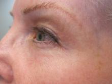 After Results for CO2 Laser Resurfacing