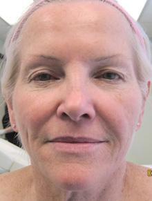 Before Results for CO2 Laser Resurfacing