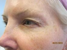 Before Results for CO2 Laser Resurfacing