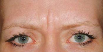 Before Results for Cosmetic