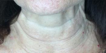 After Results for Botox