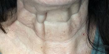 Before Results for Botox