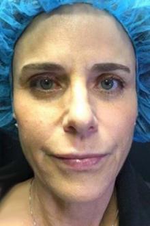 After Results for Botox