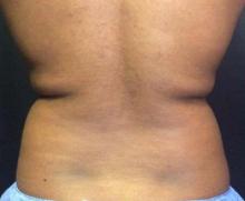 After Results for Coolsculpting