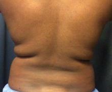 Before Results for Coolsculpting