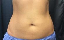 After Results for Coolsculpting