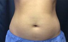 Before Results for Coolsculpting