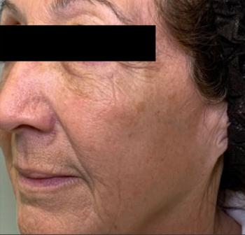 Before Results for Erbium Laser