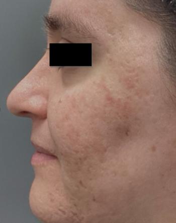 Before Results for Erbium Laser