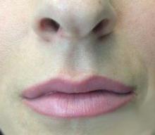 After Results for Juvederm