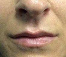 Before Results for Juvederm