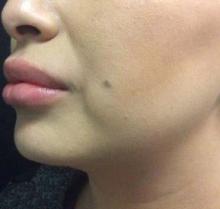 After Results for Kybella