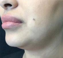 Before Results for Kybella