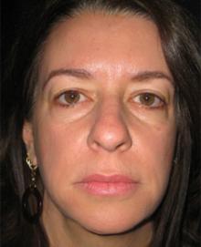 Before Results for Juvederm