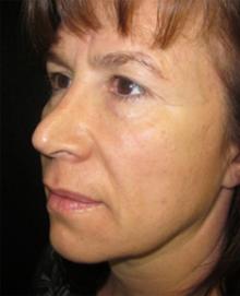 After Results for Juvederm