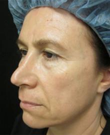 Before Results for Juvederm