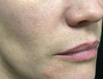 After Results for Restylane