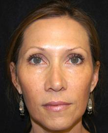 After Results for Juvederm