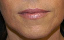 After Results for Juvederm