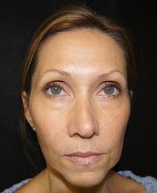 Before Results for Juvederm