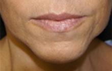 Before Results for Juvederm