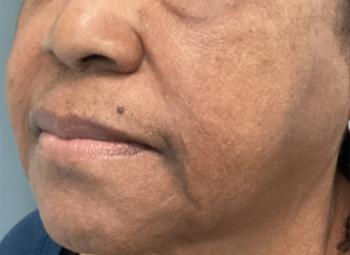 After Results for Morpheus8