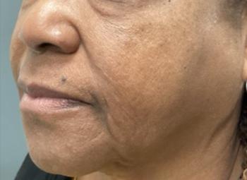 Before Results for Morpheus8