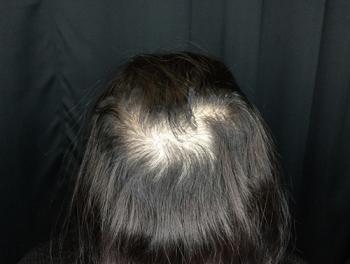 Before Results for PRP