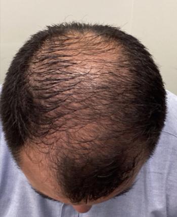 Before Results for PRP