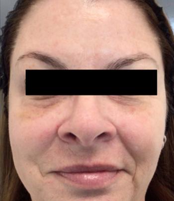 After Results for Restylane