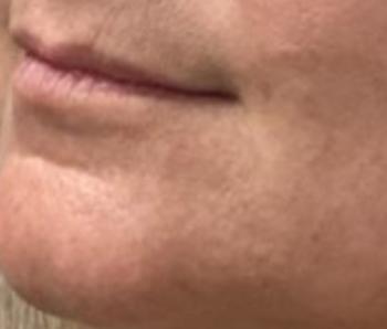 Before Results for Restylane