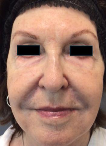After Results for Sculptra