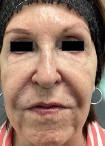 Before Results for Sculptra