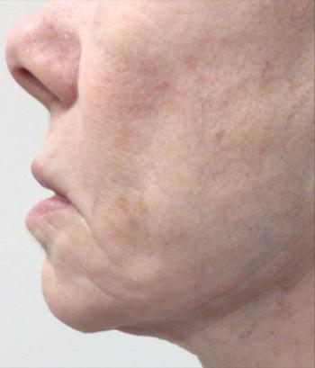 After Results for Sculptra