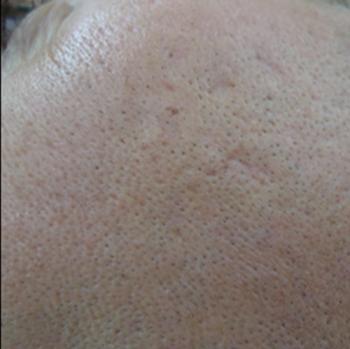 After Results for Subcision
