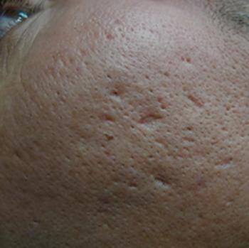Before Results for Subcision