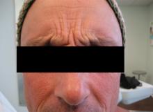Before Results for Botox
