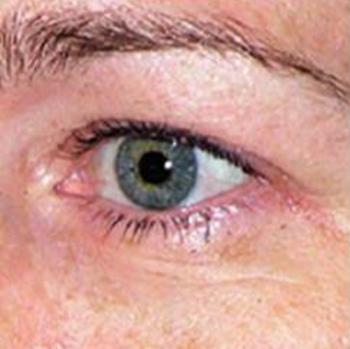 Before Results for Thermage