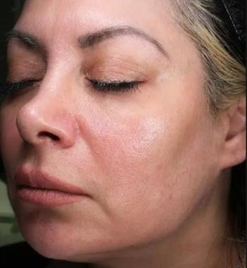 After Results for Thermage