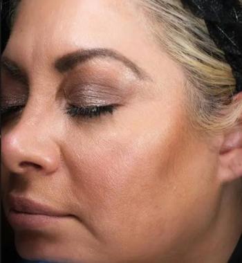 Before Results for Thermage