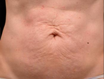 After Results for Thermage