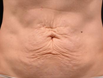 Before Results for Thermage