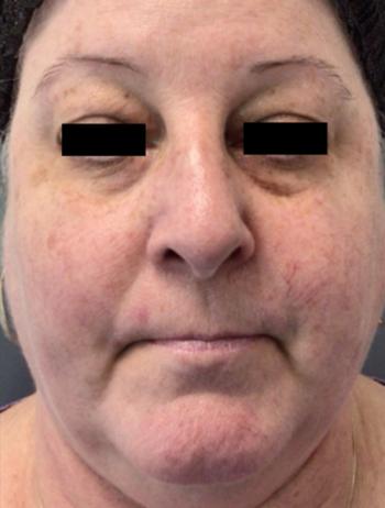 Before Results for Vbeam Laser
