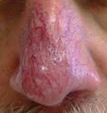 Before Results for Vbeam Laser